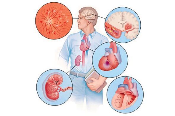 Danno a vari organi con ipertensione arteriosa prolungata